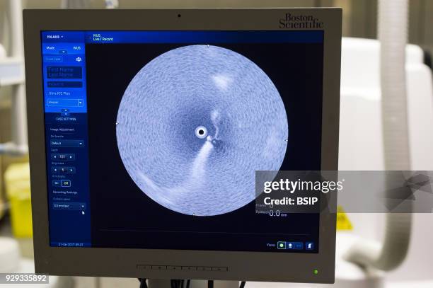 Radiofrequency ablation of cardiac arrhythmia using the Stereotaxis robotic system, by inserting a catheter into the heart, emitting radio waves that...