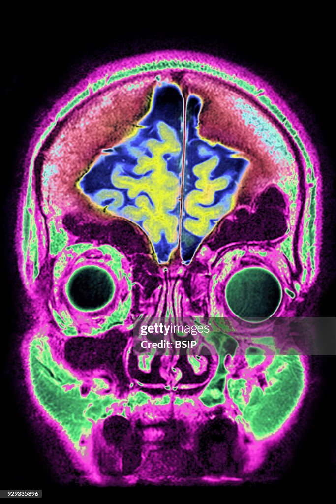 Cerebral Atrophy, MRI
