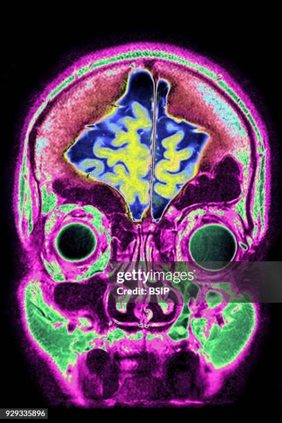 Cerebral atrophy, anterior temporal and parietal frontal Ponto cerebellar, frontal cross-section MRI cranial scan.