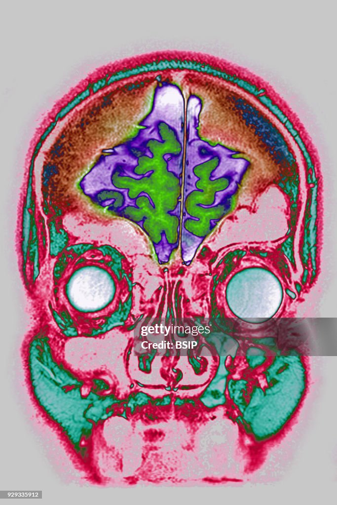 Cerebral Atrophy, MRI