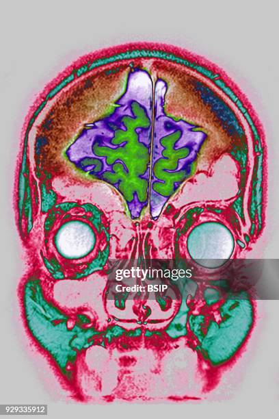Cerebral atrophy, anterior temporal and parietal frontal Ponto cerebellar, frontal cross-section MRI cranial scan.