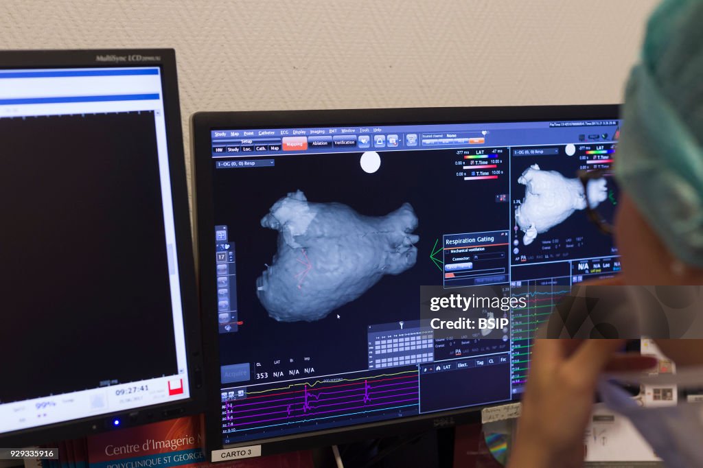 Radiofrequency Ablation
