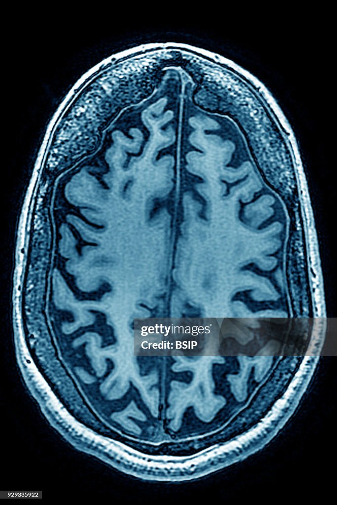 Cerebral Atrophy, MRI