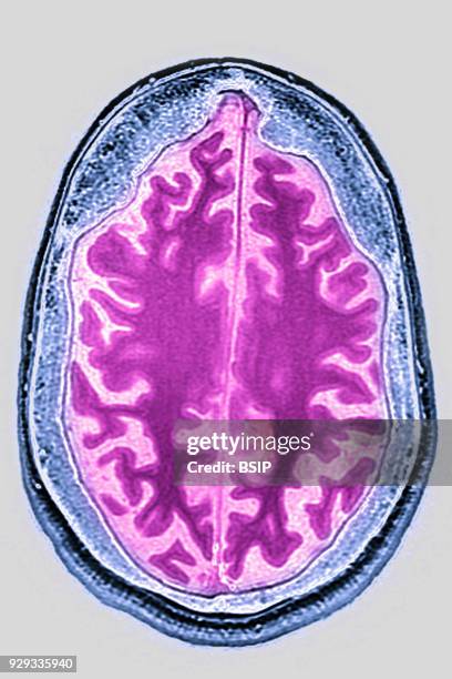 Cerebral atrophy, anterior temporal and parietal frontal Ponto cerebellar, radial cross-section MRI cranial scan.