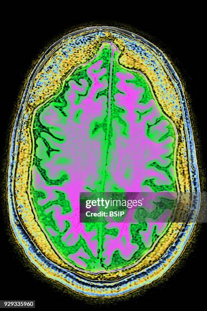 Cerebral atrophy, anterior temporal and parietal frontal Ponto cerebellar, radial cross-section MRI cranial scan.