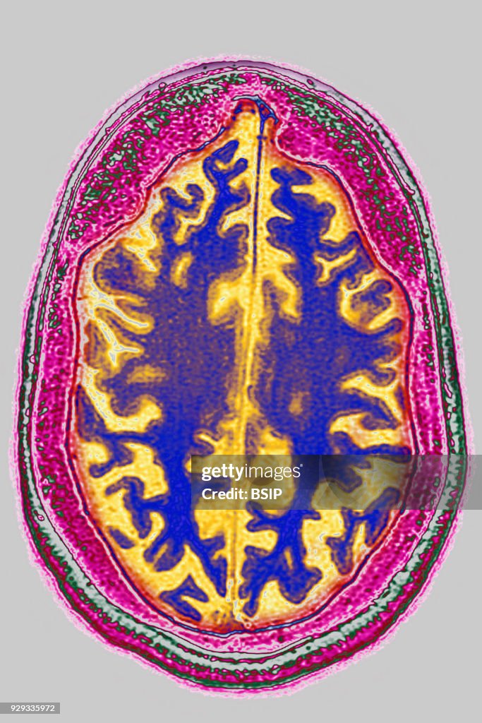 Cerebral Atrophy, MRI