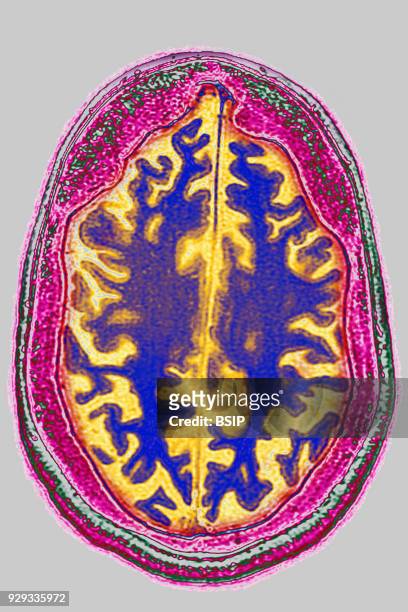 Cerebral atrophy, anterior temporal and parietal frontal Ponto cerebellar, radial cross-section MRI cranial scan.