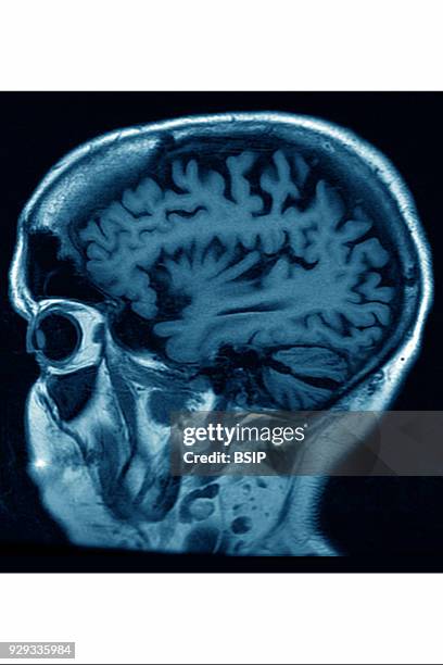 Cerebral atrophy, anterior temporal and parietal frontal Ponto cerebellar, saggital plane MRI cranial scan.