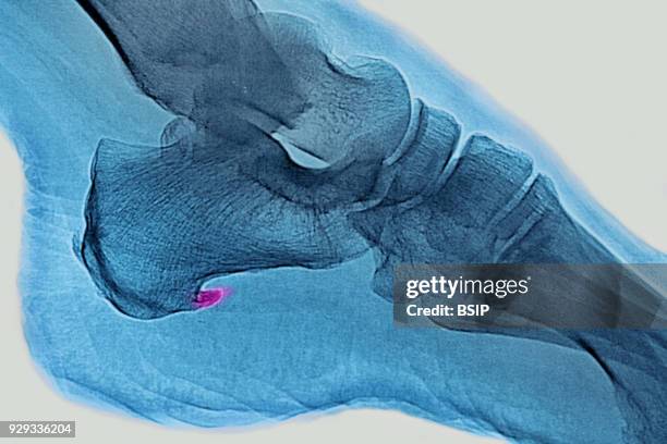 Calcifications of the plantar fascia. Visualization on saggital plane x-ray.