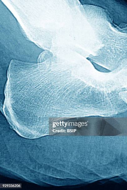 Calcifications of the plantar fascia. Visualization on saggital plane x-ray.