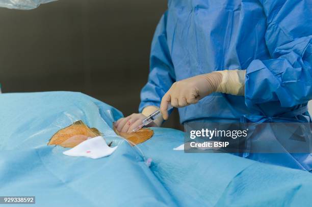 Radiofrequency ablation of cardiac arrhythmia using the Stereotaxis robotic system, by inserting a catheter into the heart, emitting radio waves that...