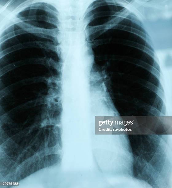 x-ray - x ray image fotografías e imágenes de stock