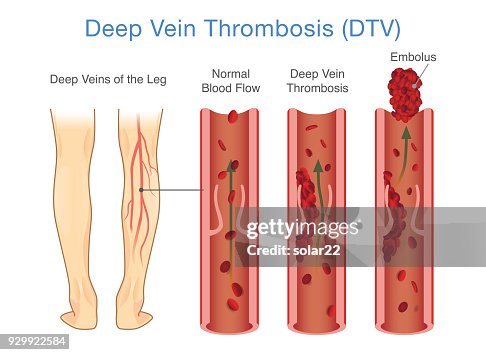 Possible Dvt Medical Diagram Of Deep Vein Thrombosis At Leg Area High-Res Vector ...