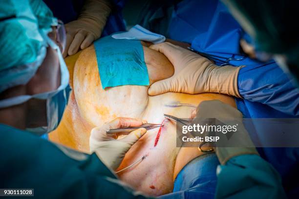 Gynecology surgery, Chambery Metropole Savoie Hospital, France, Breast conservation surgery on 67-year old breast cancer patient, removal of the...