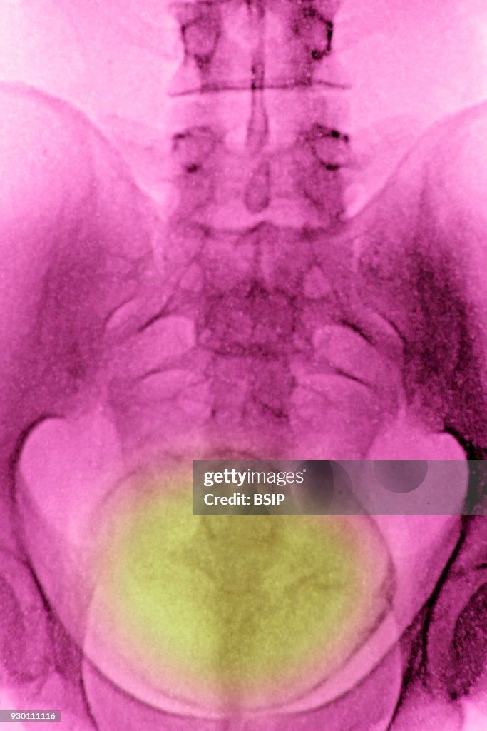 Urinary Schistosomiasis