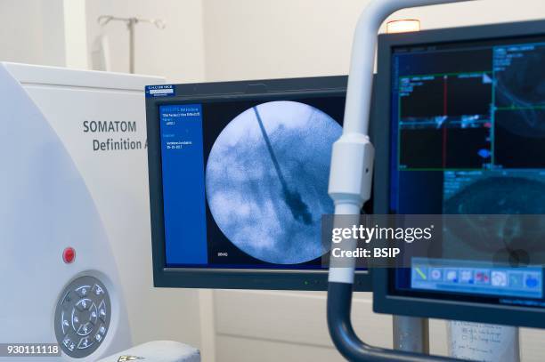 Interventional scanner service, Pasteur 2 Hospital, Nice, France, Vertebroplasty, cementoplasty operation to treat a vertebral facture, technique...