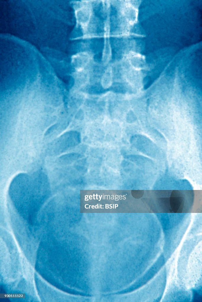 Urinary Schistosomiasis