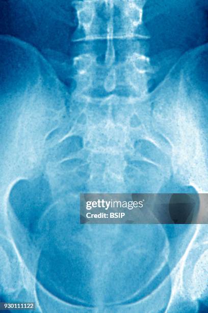 Ray of urinary schistosomiasis. Frontal pelvic x-ray.