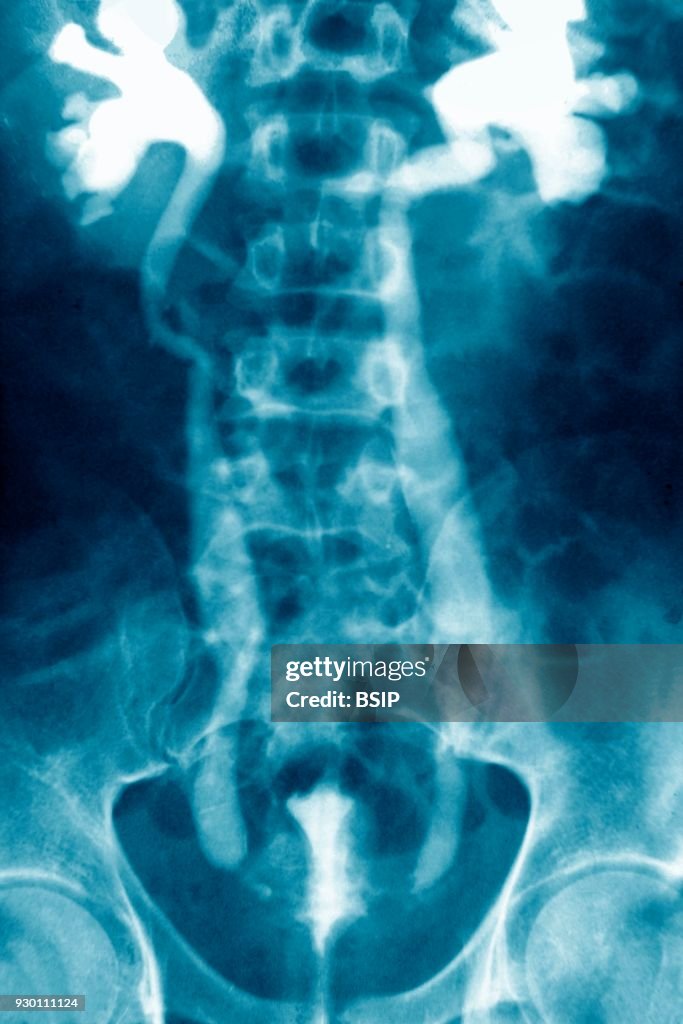 Urinary Schistosomiasis