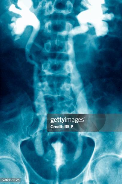 Ray of urinary schistosomiasis. Frontal abdominal-pelvic x-ray.