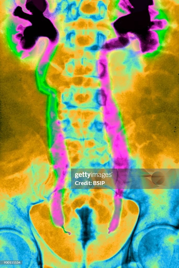 Urinary Schistosomiasis