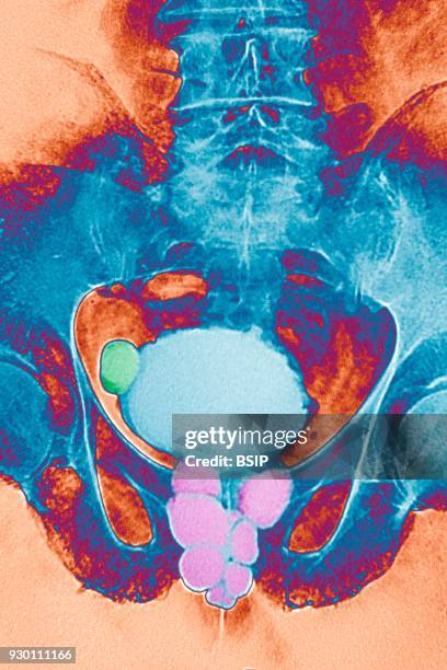 Prostate caverns and diverticulum in the bladder. Frontal pelvic x-ray.