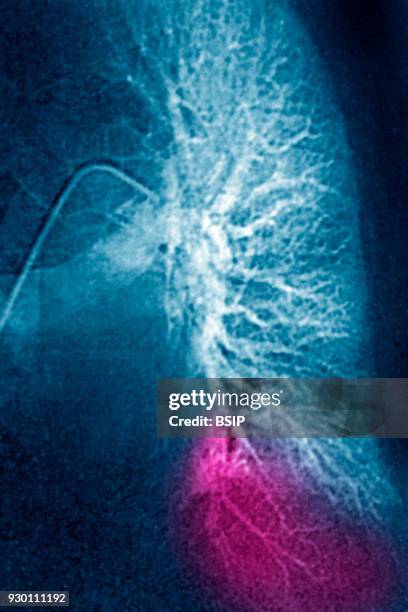 Infarction in the lower left lobe following a pulmonary embolism. Frontal angiography.