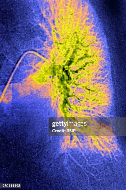 Infarction in the lower left lobe following a pulmonary embolism. Frontal angiography.