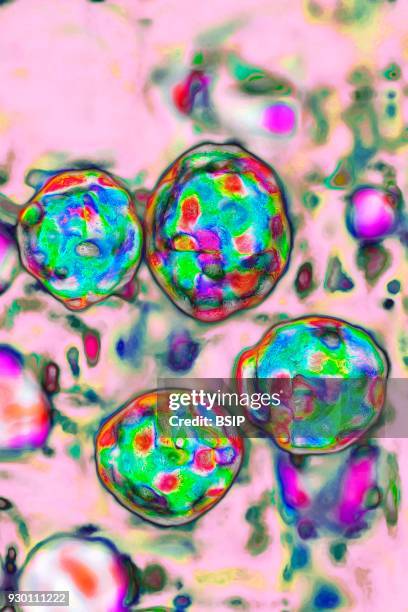 The measles virus, paramyxoviridae from the Morbillivirus family, transmission microscopy view.