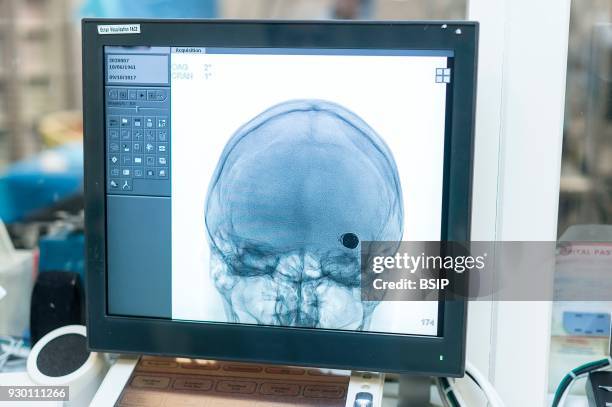 Interventional neuroradiology, Pasteur 2 Hospital, Nice, France, Treating a cerebral aneurysm through embolization, an endovascular treatment...