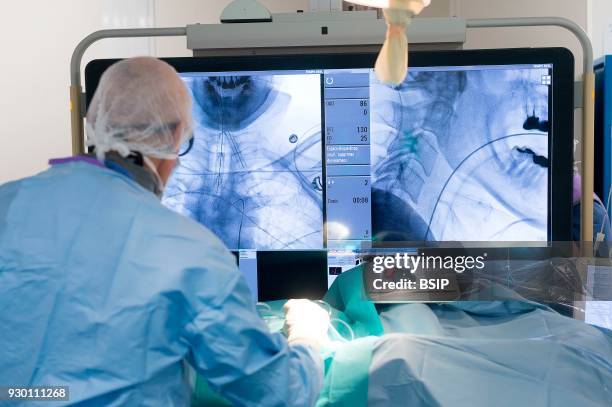 Interventional neuroradiology, Pasteur 2 Hospital, Nice, France, Treating a cerebral aneurysm through embolization, an endovascular treatment...