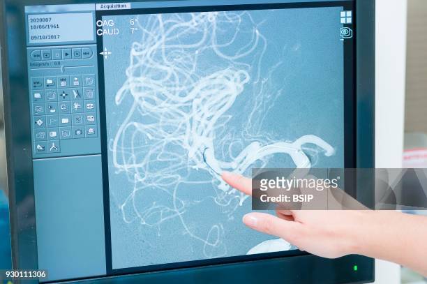 Interventional neuroradiology, Pasteur 2 Hospital, Nice, France, Treating a cerebral aneurysm through embolization, an endovascular treatment...