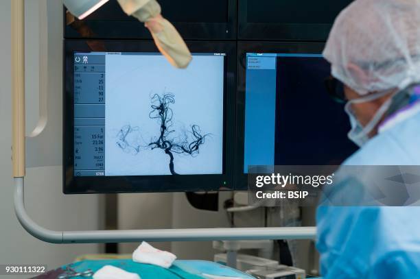 Interventional neuroradiology, Pasteur 2 Hospital, Nice, France, Emergency treatment of an ischemic stroke through thrombectomy. This procedure...