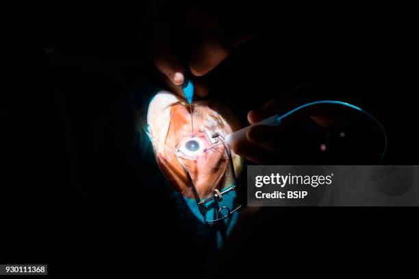 Reportage in the ophthalmology service in Pasteur 2 Hospital, Nice, France. In the operating theatre, treatment of a retinal detachment through...