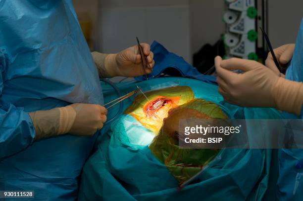 Stereotactic Neurosurgery operation, Pasteur 2 Hospital, Nice, France, Treating Parkinsons disease through deep brain stimulation, by implanting...
