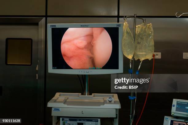 Orthopedic surgery, Saint George Clinic, Nice, France, Treating a torn cruciate ligament using the Sambba technique, carried out under arthroscopy,...