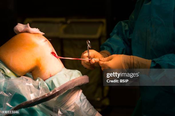 Orthopedic surgery, Saint George Clinic, Nice, France, Treating a torn cruciate ligament using the Sambba technique, carried out under arthroscopy,...
