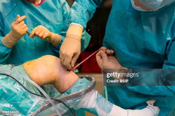 Orthopedic surgery, Saint George Clinic, Nice, France, Treating a torn cruciate ligament using the Sambba technique, carried out under arthroscopy,...