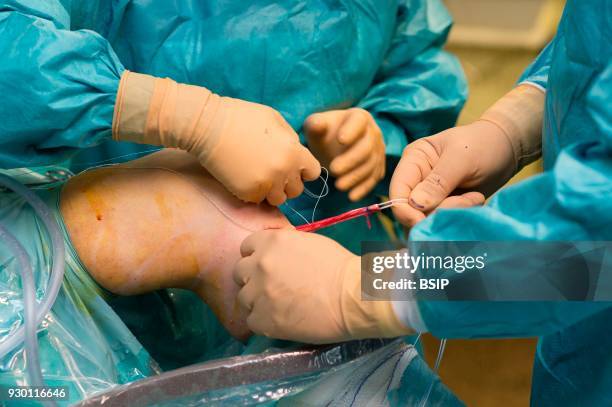 Orthopedic surgery, Saint George Clinic, Nice, France, Treating a torn cruciate ligament using the Sambba technique, carried out under arthroscopy,...