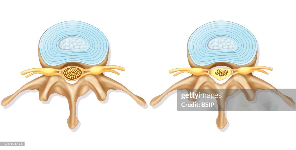 Spinal Stenosis