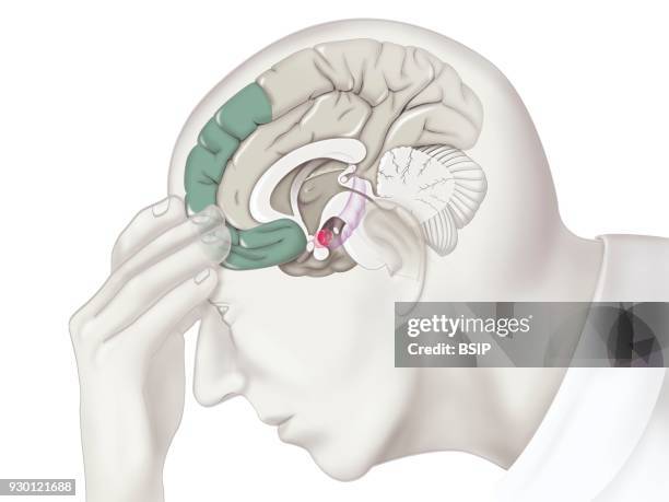 Illustration of the areas in the brain involved in the process of depression. Lessening in volume and activity of the prefrontal cortex and the...