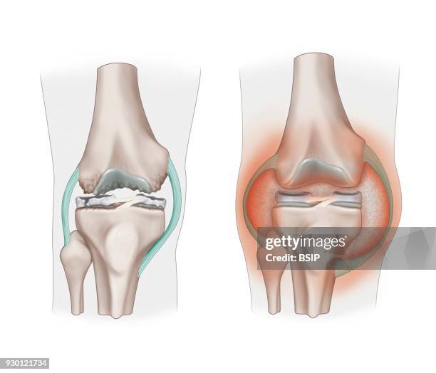 Illustration of osteoarthritis and arthritis of the knee. On the left, osteoarthritis of the knee showing meniscal deterioration, going as far as a...