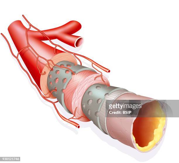 Illustration of an atheromatous plaque, fatty build up in a medium caliber artery. The plaque slows blood flow, which can cause cardio-vascular...
