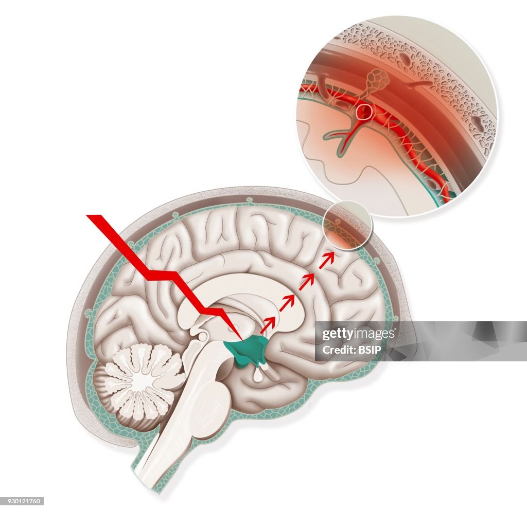 Migraine, Illustration