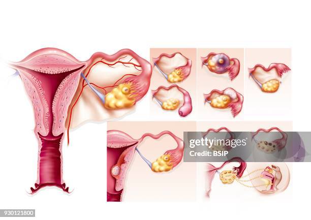 Illustration of the causes of female infertility. On the left, illustration of the female genital organs. Top right, illustration of various...