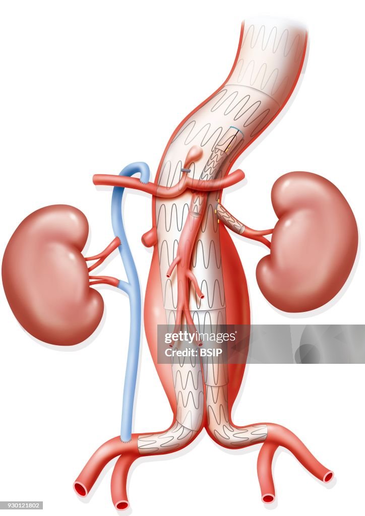 Aneurysm Treatment