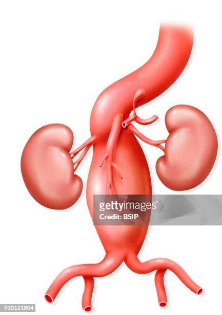 Illustration of an abdominal aortic aneurysm, located below the superior mesenteric artery, narrow stenosis of the celiac axis and early bifurcation...