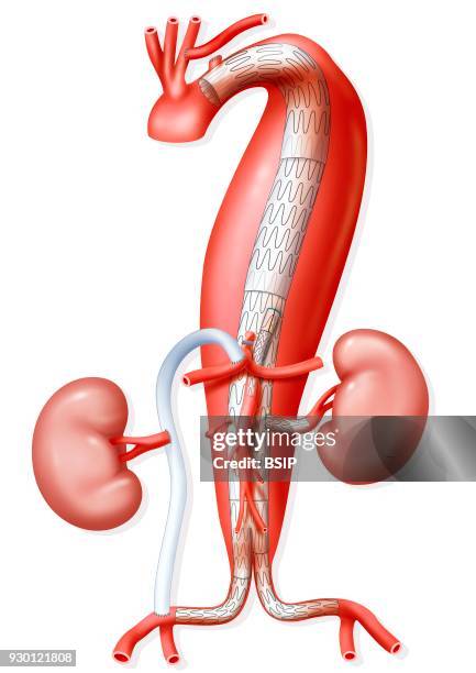 Illustration of surgery for an aortic aneurysm with the placement of an endoprosthesis in the aorta, from the brachiocephalic artery and forking at...