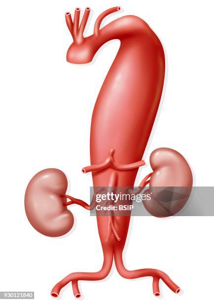 Illustration of an aortic aneurysm just before the left subclavian artery and as far as the aortic bifurcation. The right renal artery shows an...