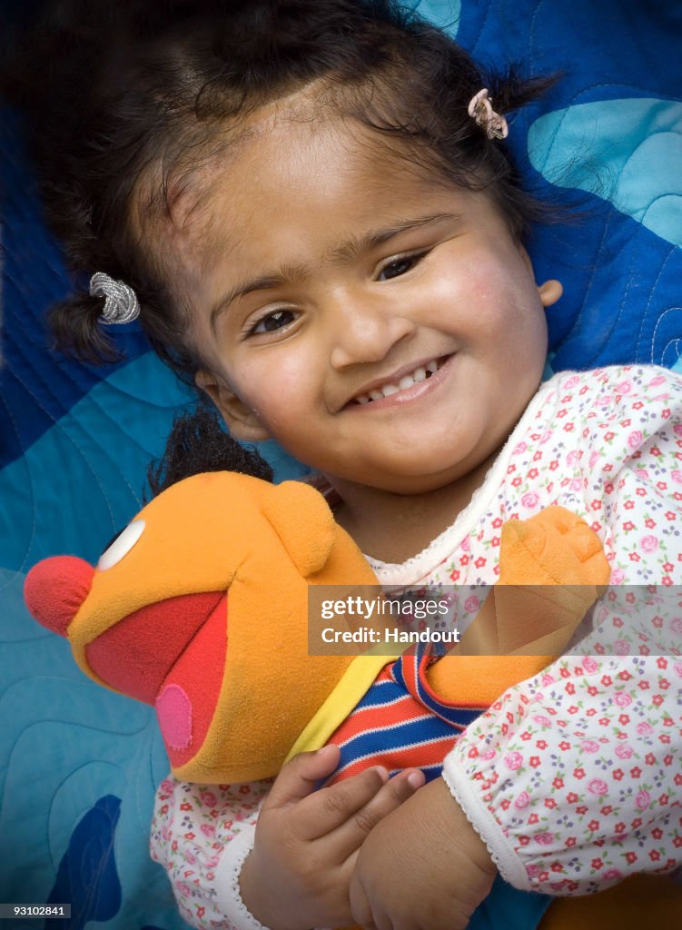 Separation Of Cojoined Twins Trishna & Krishna Completed Successfully